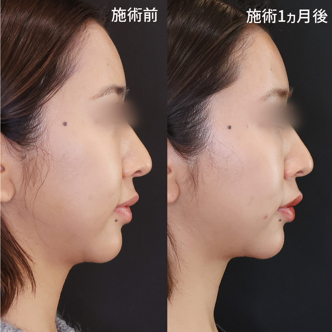 TAC式 ツヤ肌コラーゲンリフト®の症例写真 施術前後 