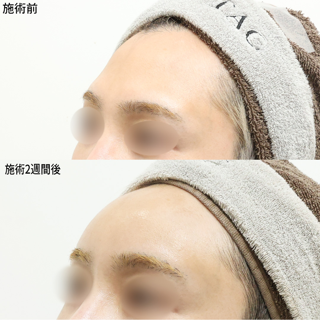 《プチ整形》で額の印象一気に変える