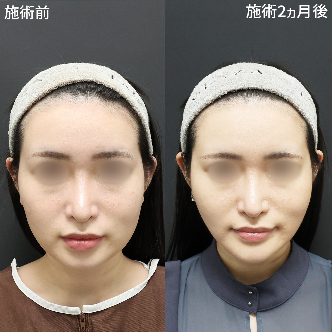 TAC式 ツヤ肌コラーゲンリフト®/バッカルファット除去/ジョールファット除去の症例写真 施術前後 
