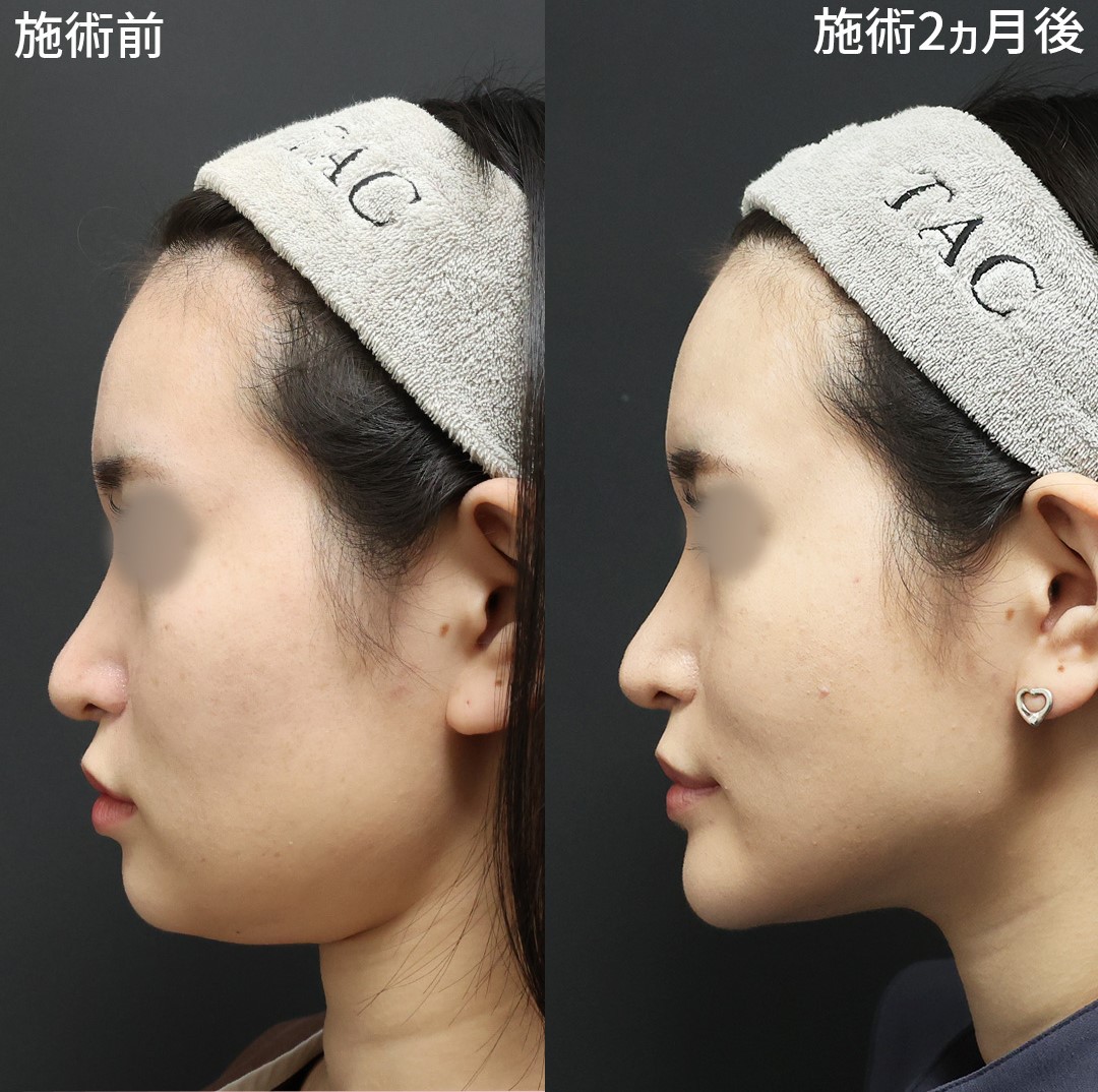 《小顔施術》で別人級の横顔へ