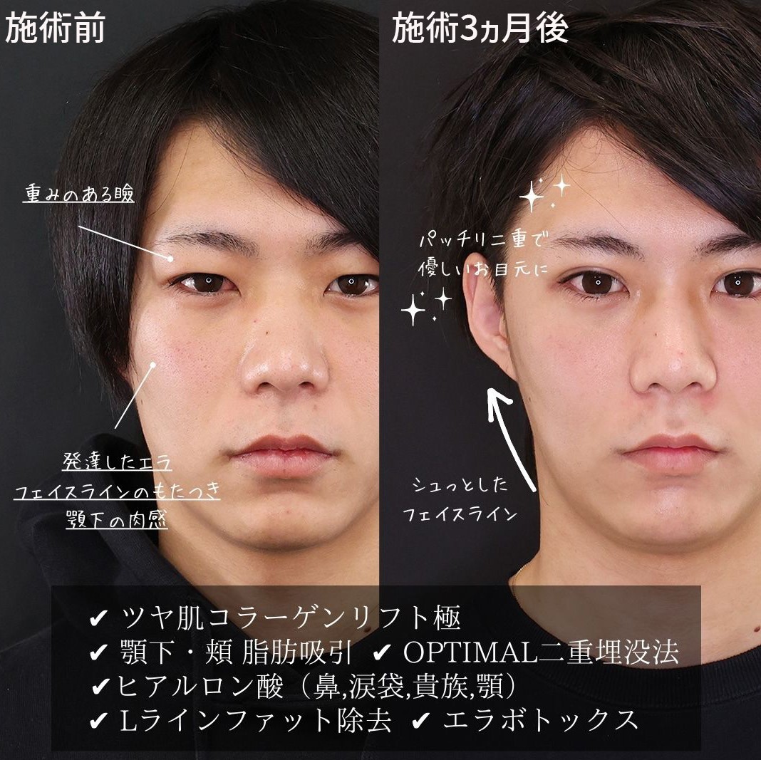 Lラインファット除去(エラ下脂肪除去)/クイックコスメリング/TAC式 ツヤ肌コラーゲンリフト®の症例写真 施術前後