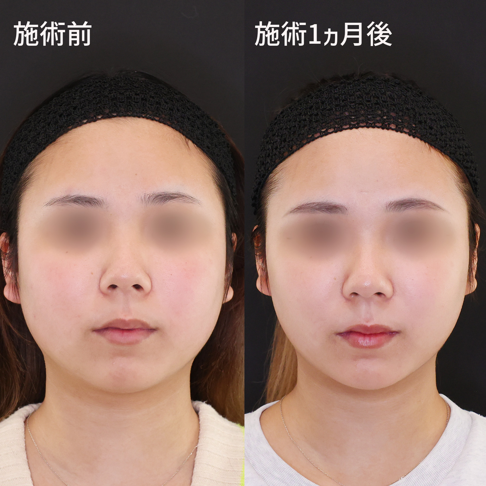 垢抜け小顔！【糸リフト×ジョールファット除去×顎ヒアルロン酸注入×エラボトックス】