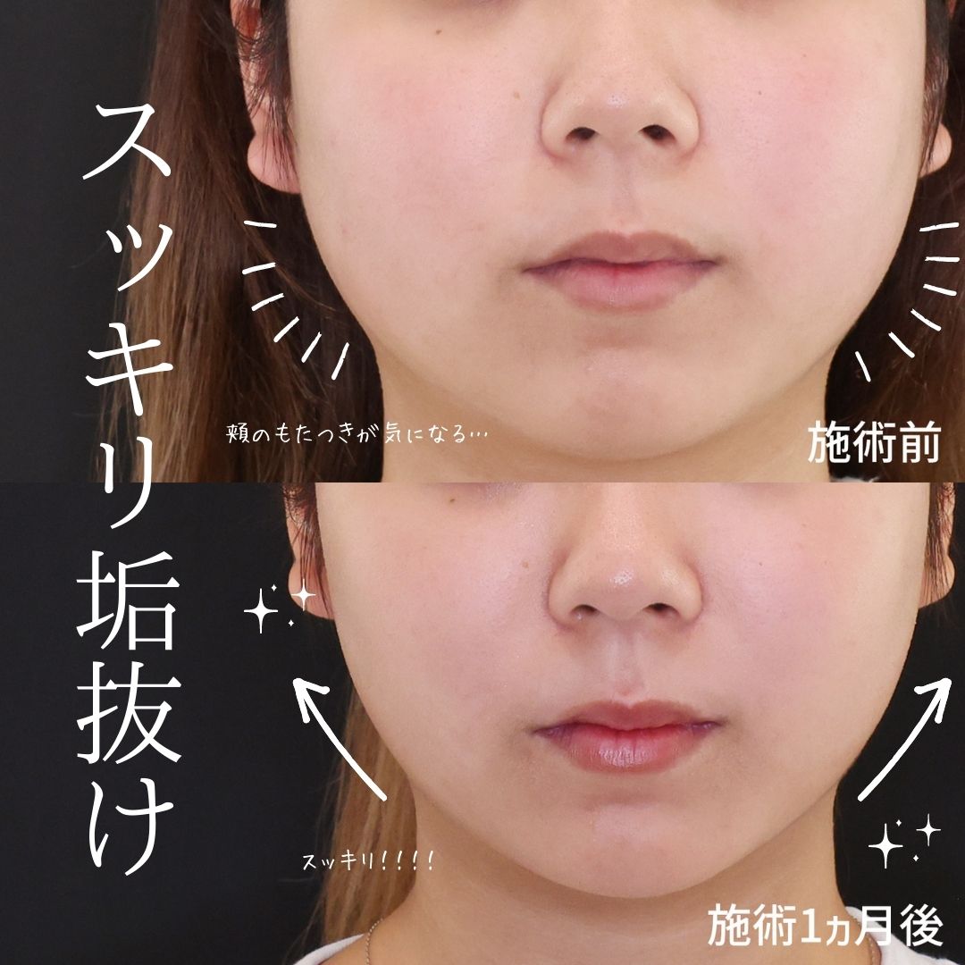 ジョールファット除去/TAC式 ツヤ肌コラーゲンリフト®/エラボトックス注射の症例写真 施術前後 
