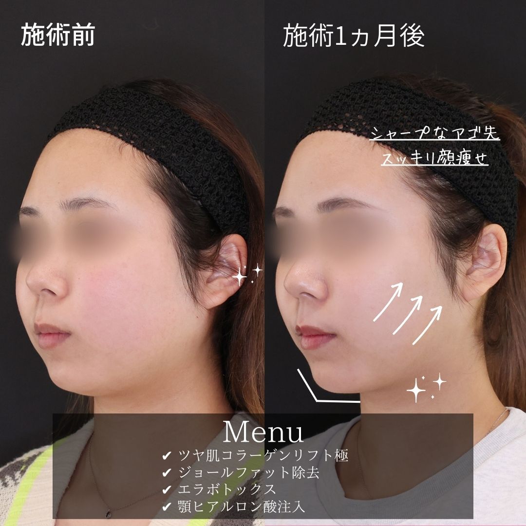 ジョールファット除去/TAC式 ツヤ肌コラーゲンリフト®/エラボトックス注射の症例写真 施術前後 