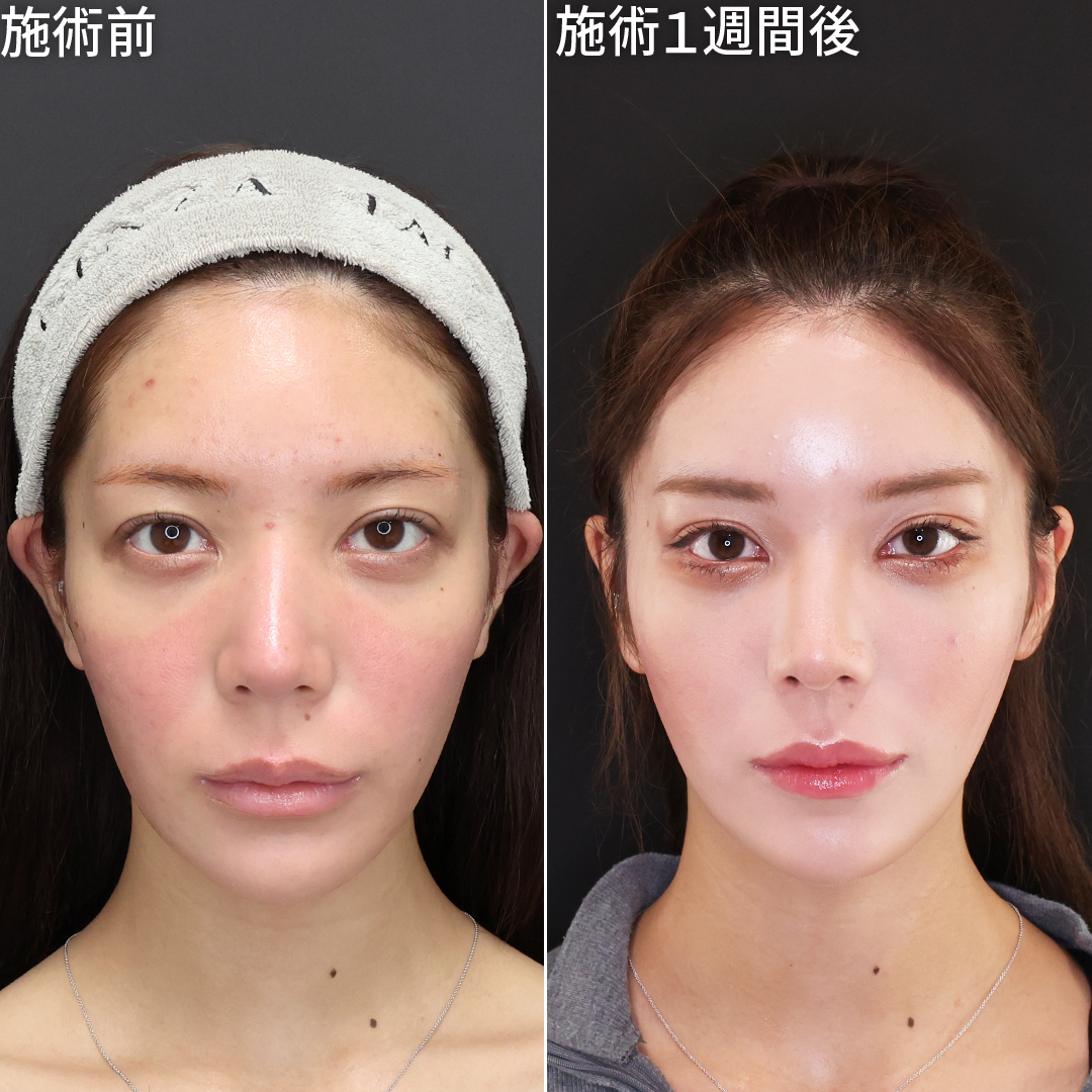 面長な印象を改善！美しい卵型のフェイスラインに