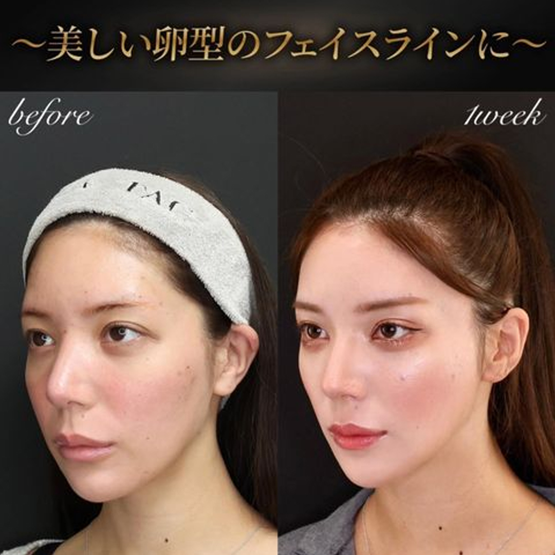 TAC式 ツヤ肌コラーゲンリフト®の症例写真 施術前後 