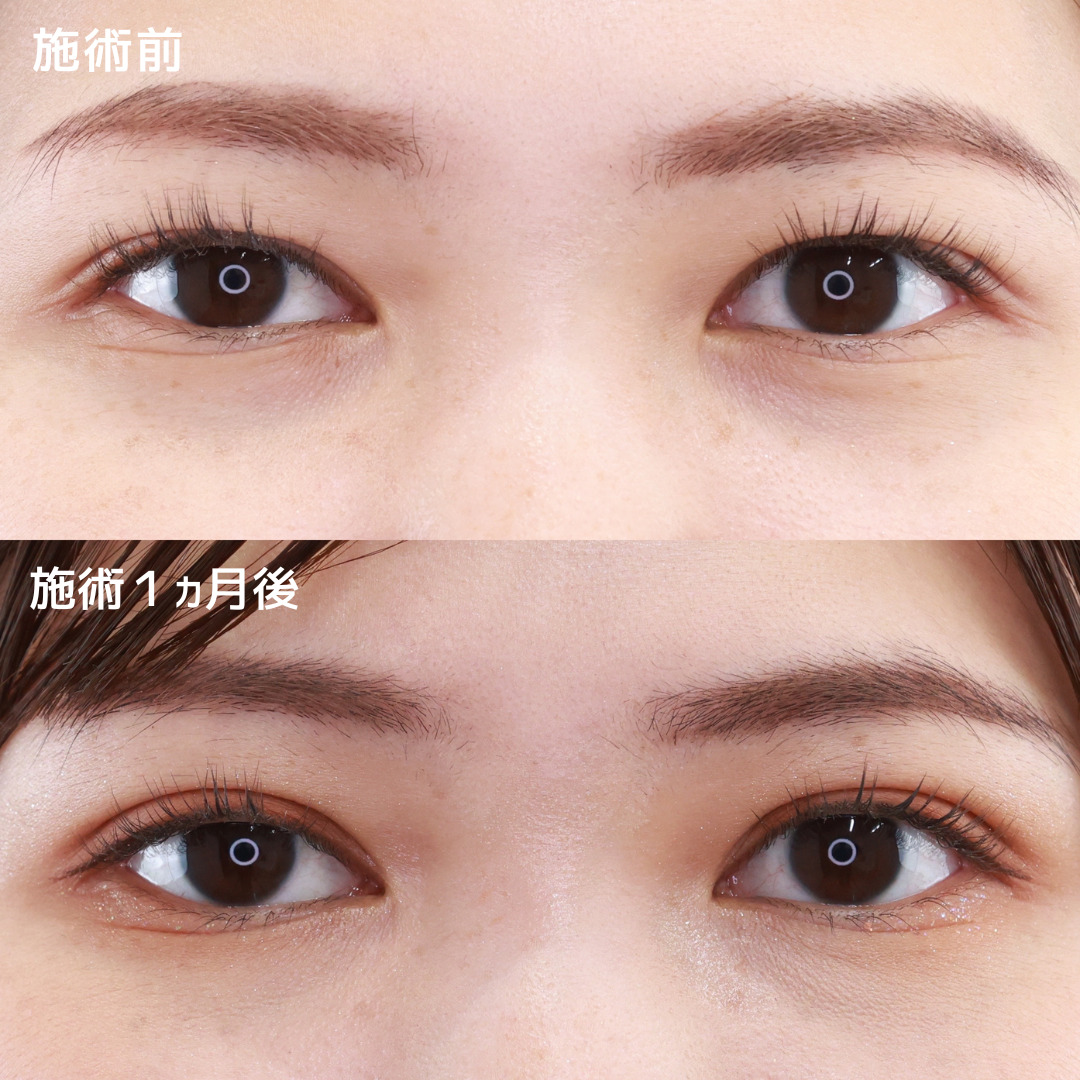【クイックコスメリング】施術直後から可愛い二重へ
