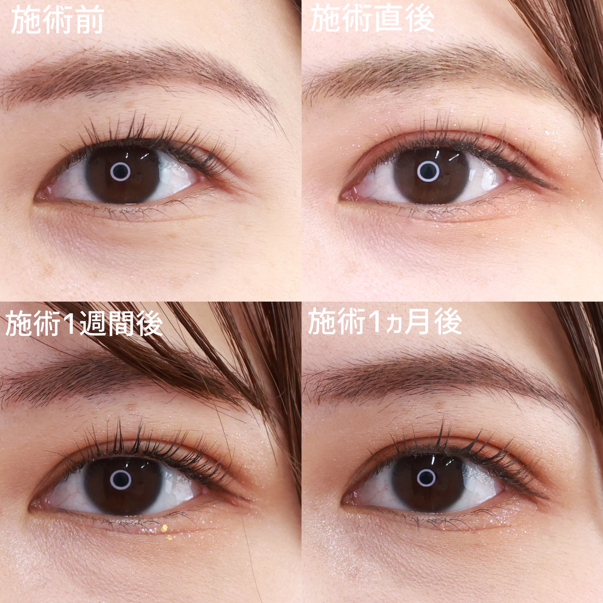 クイックコスメリングの症例写真 施術前後 