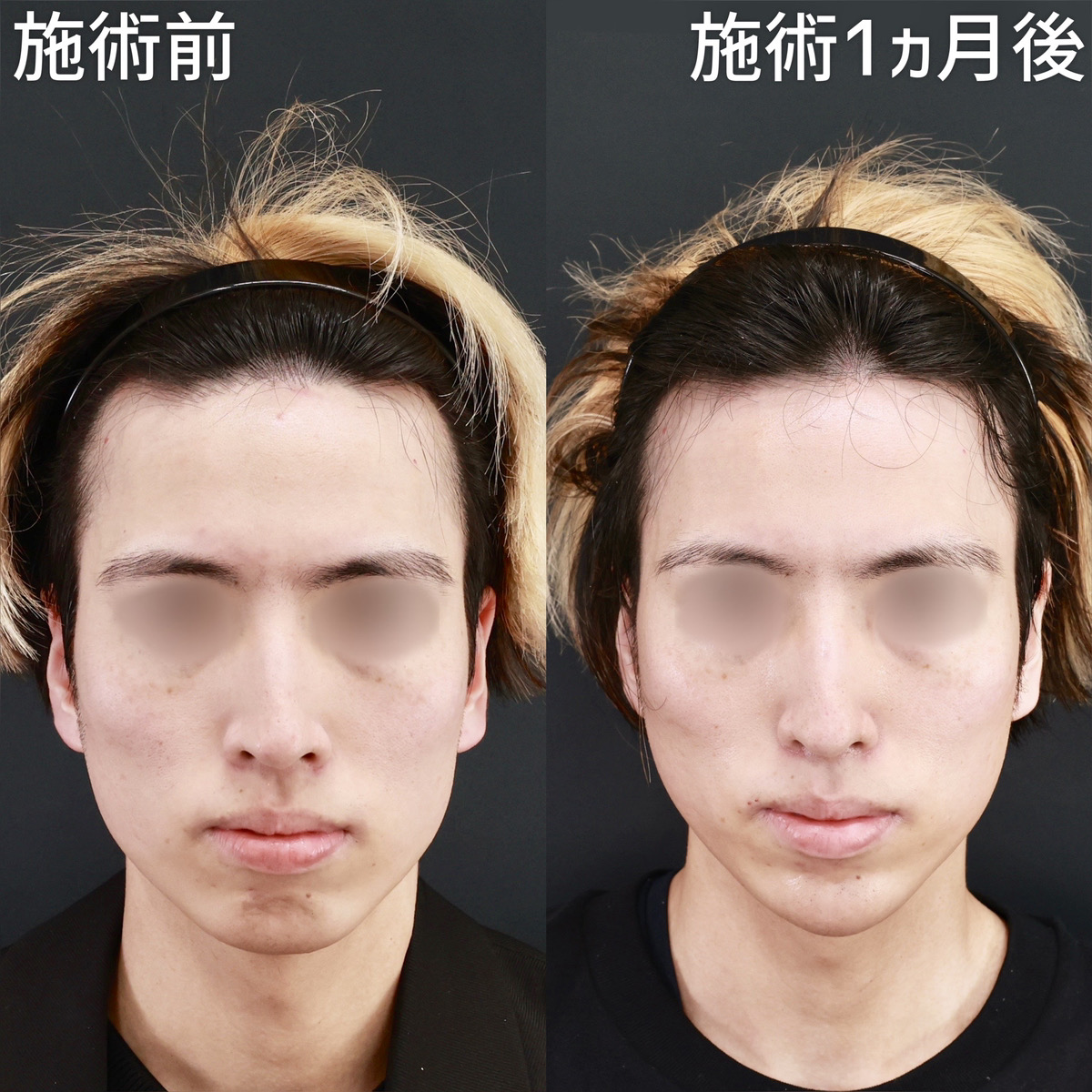 【糸リフト＆顎ヒアルロン酸】短いダウンタイムで小顔に！