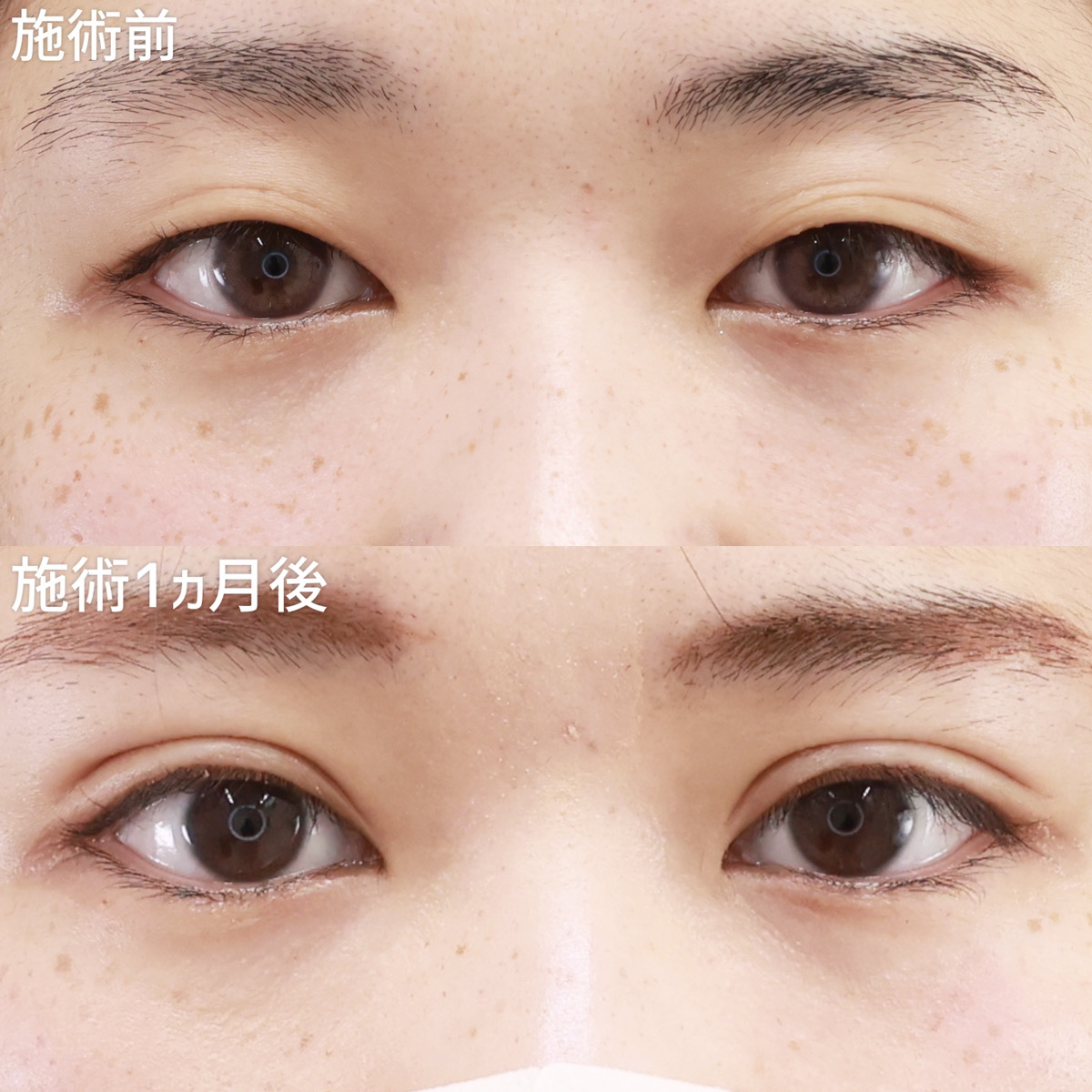 【二重埋没法】たった数分で終わるプチ整形でも垢抜けます！