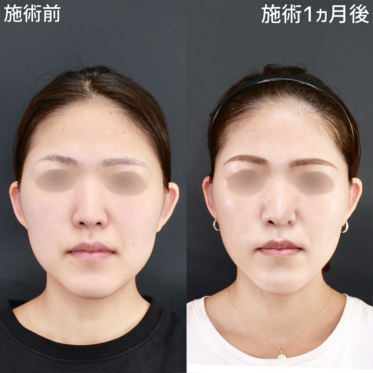 【糸リフト＆ジョールファット除去】口周りのもたつきスッキリ！面長感の改善も！