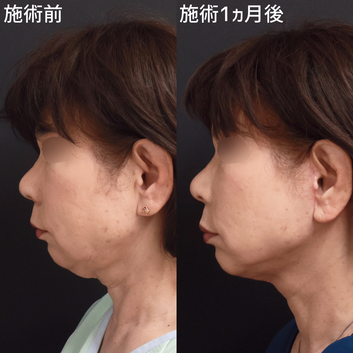 フェイスリフト（切開）の症例写真 施術前後 