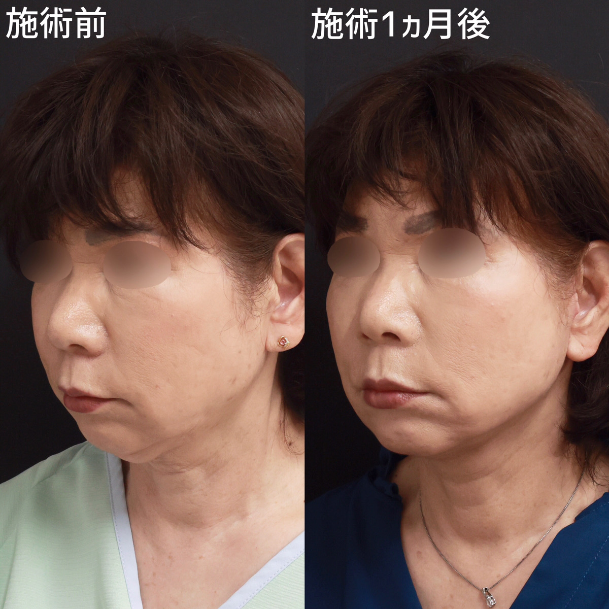 フェイスリフト（切開）の症例写真 施術前後 