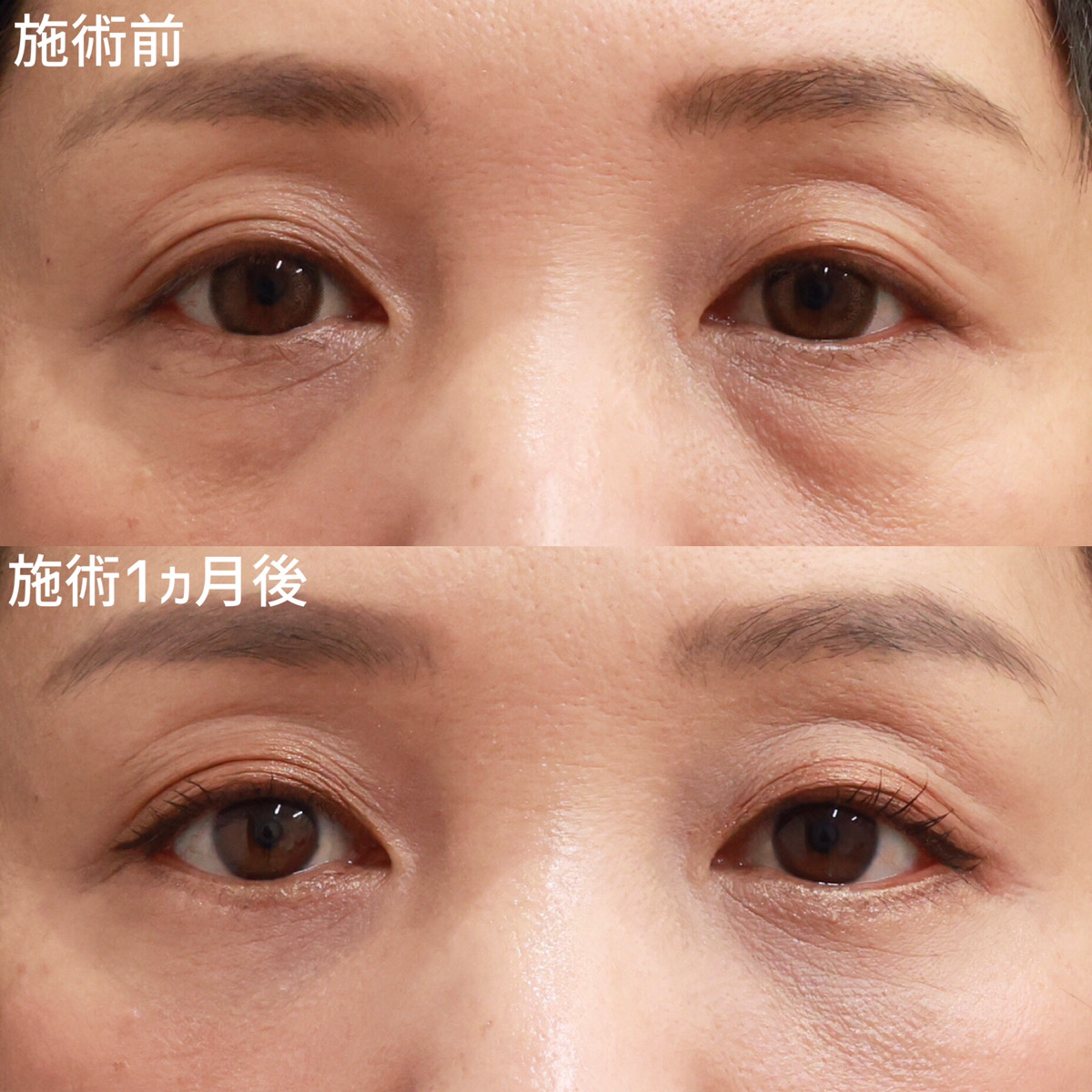 【目元の複合施術】目の下のふくらみとたるみを撃退！