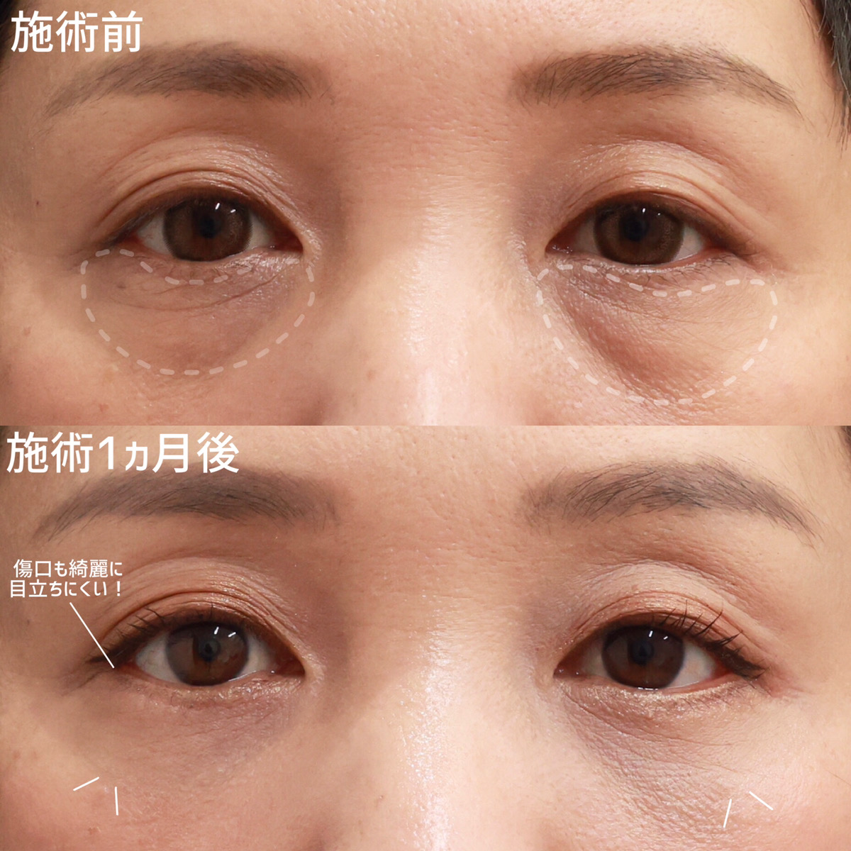 下眼瞼脱脂術（目の下のたるみ取り・目の下の脂肪ふくらみ取り）/下眼瞼切開術（クマ・たるみとり）/顔の脂肪注入(コンデンスリッチフェイス)の症例写真 施術前後 