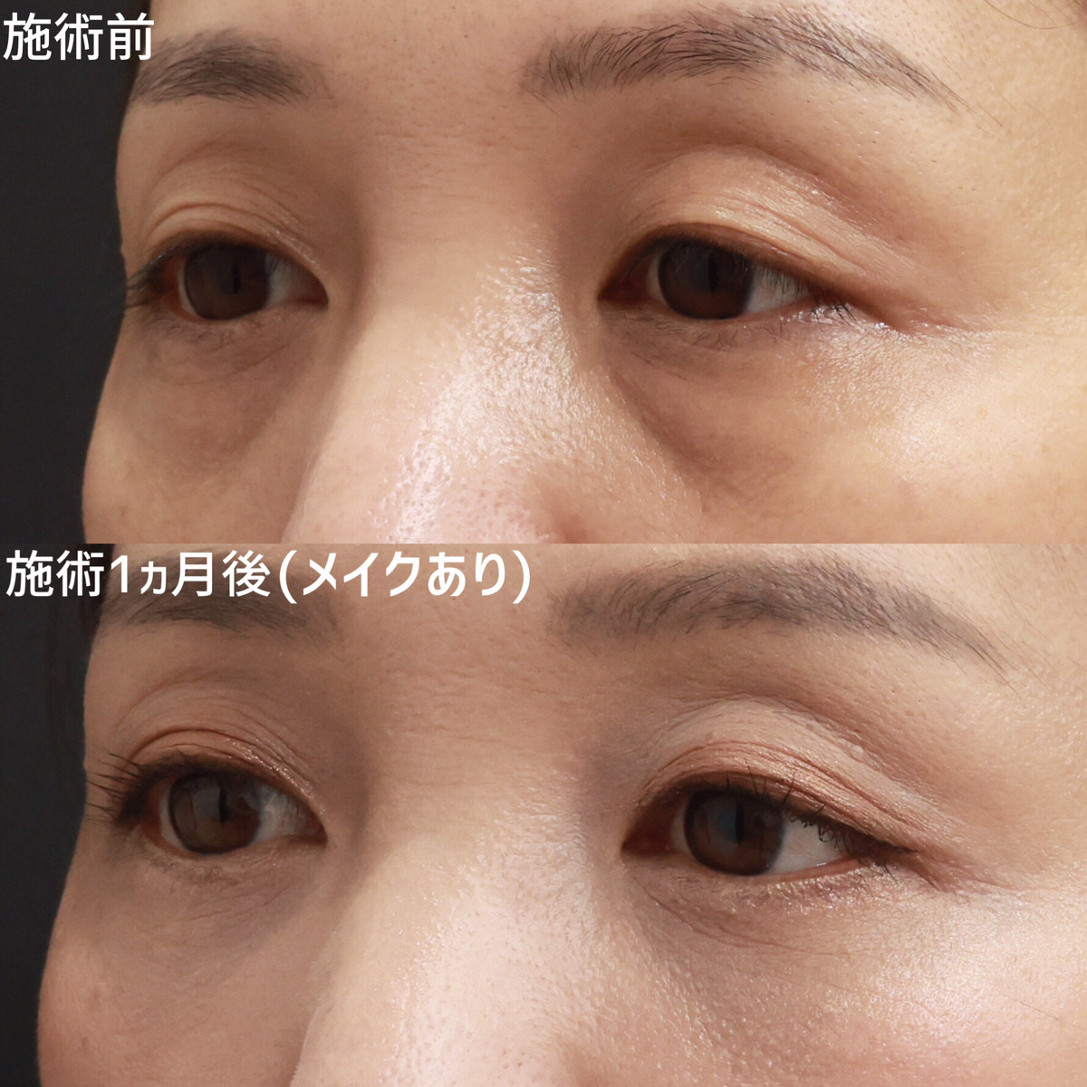 下眼瞼脱脂術（目の下のたるみ取り・目の下の脂肪ふくらみ取り）/下眼瞼切開術（クマ・たるみとり）/顔の脂肪注入(コンデンスリッチフェイス)の症例写真 施術前後 