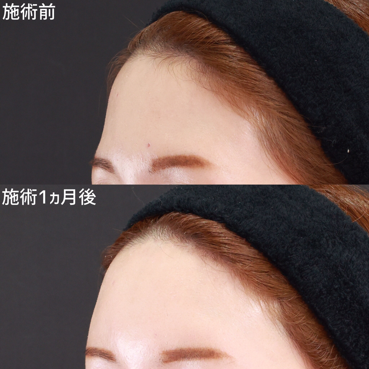 【オルチャンデコ】定着率の高い脂肪注入で3ヵ月後もツヤっと滑らかな額