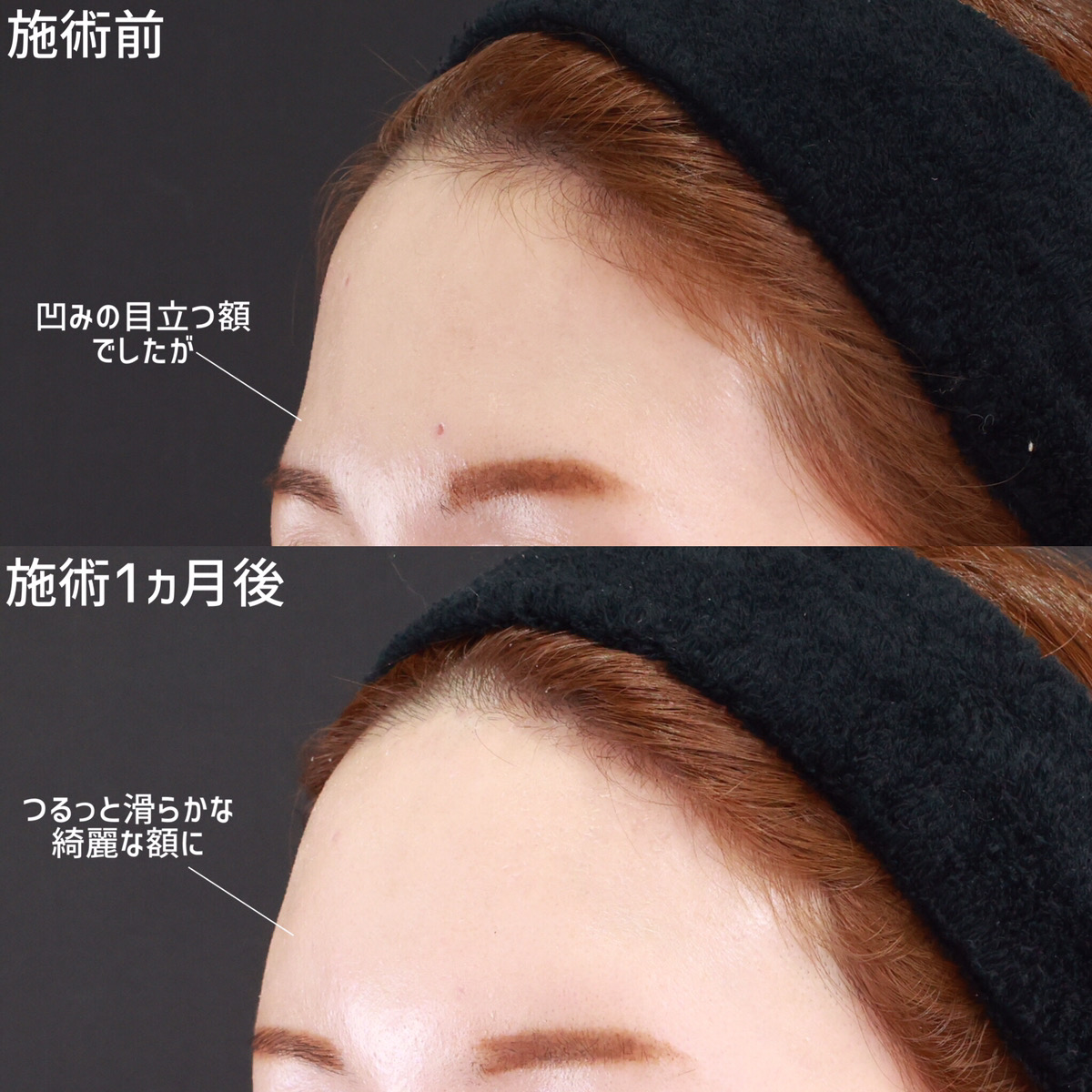 おでこの脂肪注入（オルチャンデコ形成）の症例写真 施術前後 