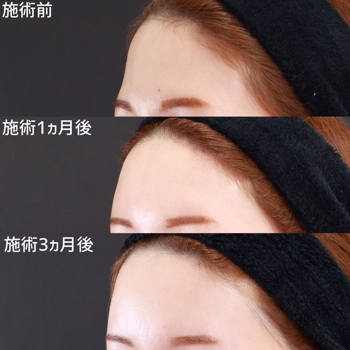 おでこの脂肪注入（オルチャンデコ形成）の症例写真 施術前後 