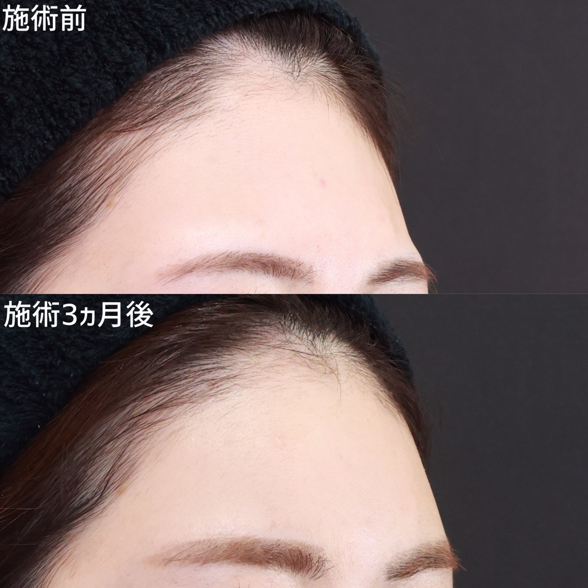 【オルチャンデコ】眉上の凹みを改善！女性らしい額をGET！