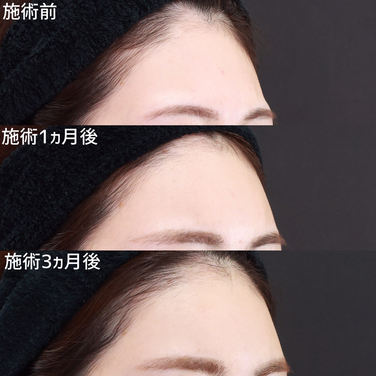 おでこの脂肪注入（オルチャンデコ形成）の症例写真 施術前後 