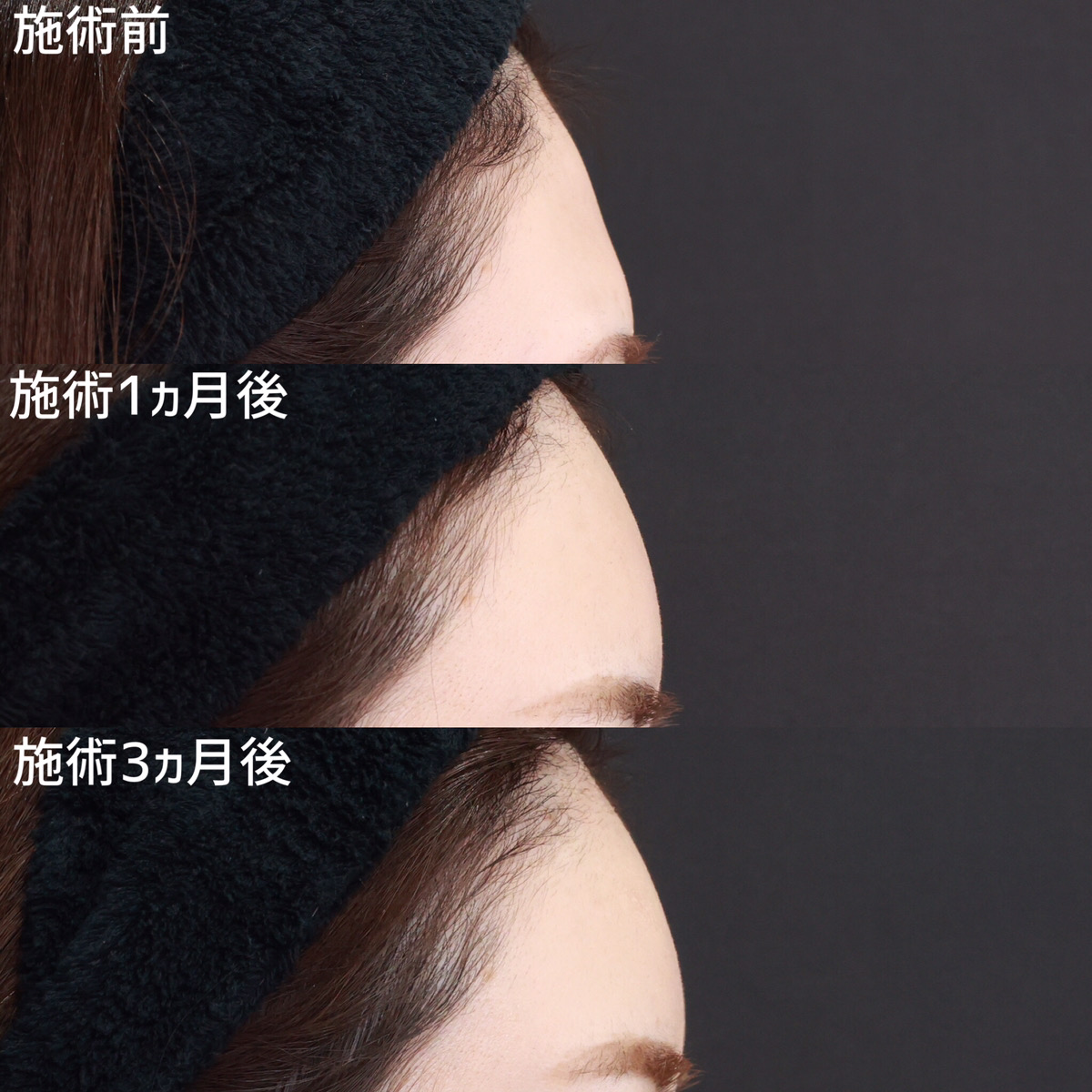 おでこの脂肪注入（オルチャンデコ形成）の症例写真 施術前後 