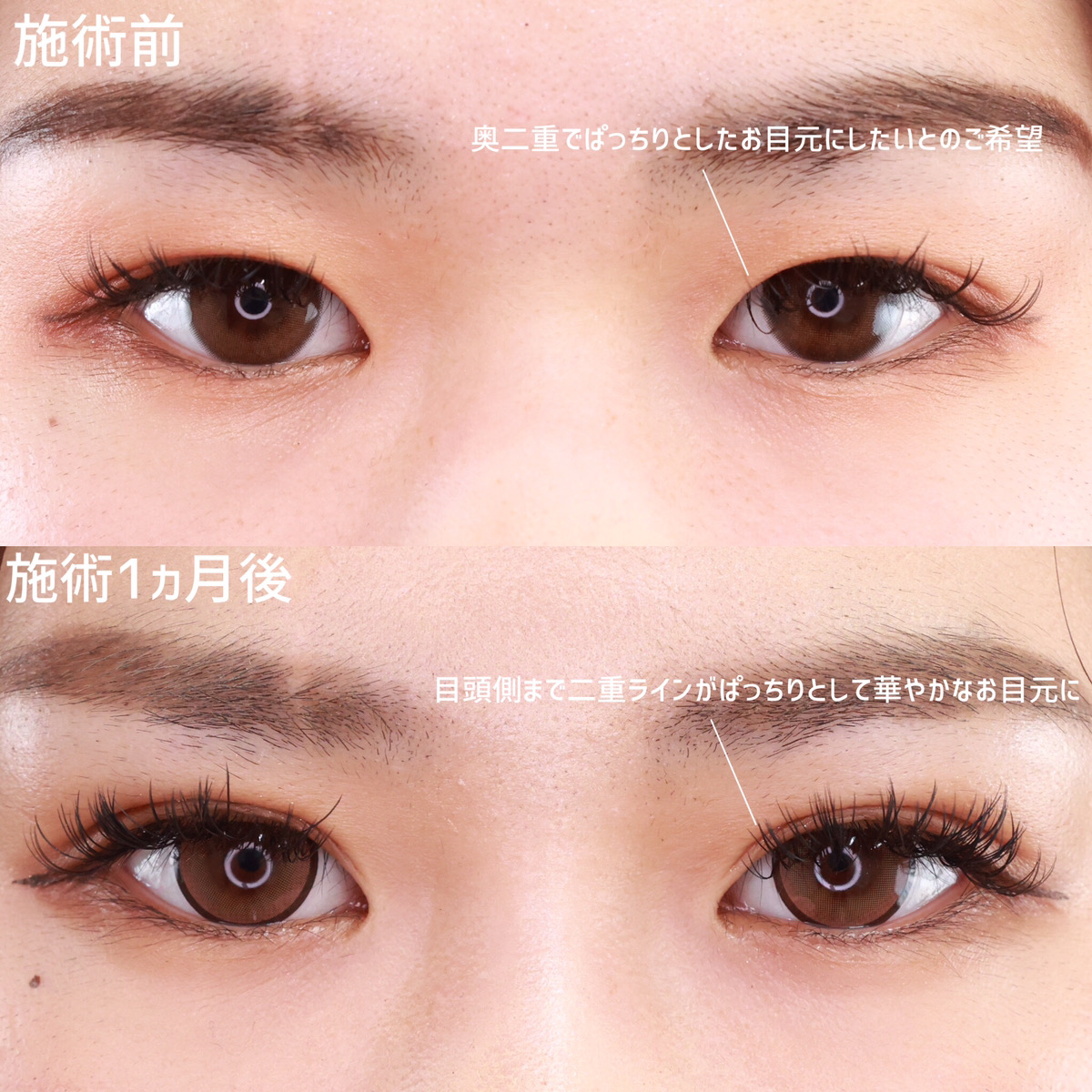 二重埋没法/目元：その他の症例写真 施術前後 