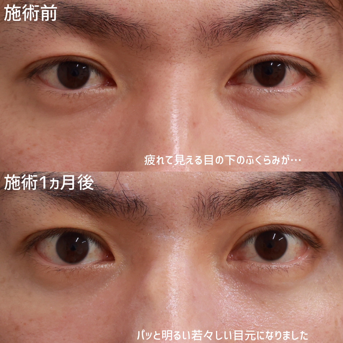 下眼瞼脱脂術（目の下のたるみ取り・目の下の脂肪ふくらみ取り）/顔の脂肪注入(コンデンスリッチフェイス)の症例写真 施術前後 