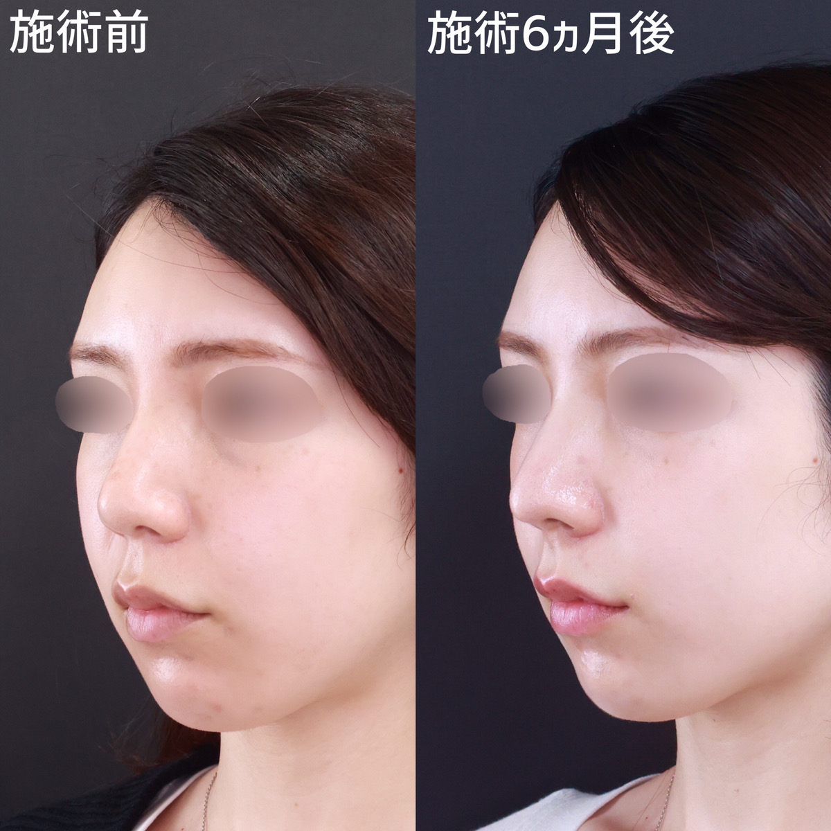 鼻尖形成・鼻尖縮小/鼻先軟骨移植の症例写真 施術前後 