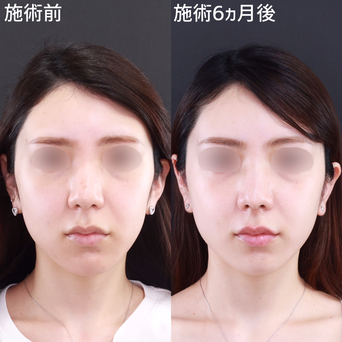 鼻尖形成・鼻尖縮小/鼻先軟骨移植の症例写真 施術前後 