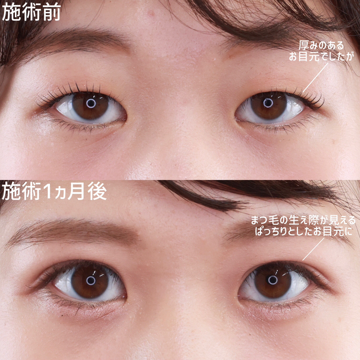 二重埋没法/目元:その他の症例写真 施術前後