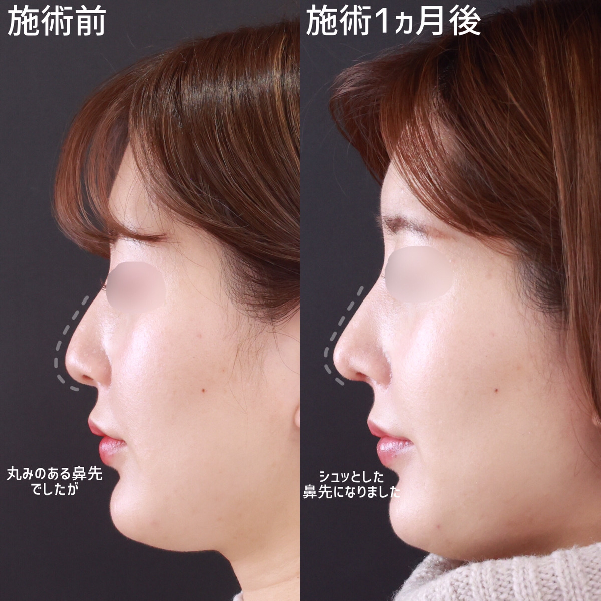 鼻尖形成・鼻尖縮小/鼻先軟骨移植の症例写真 施術前後 