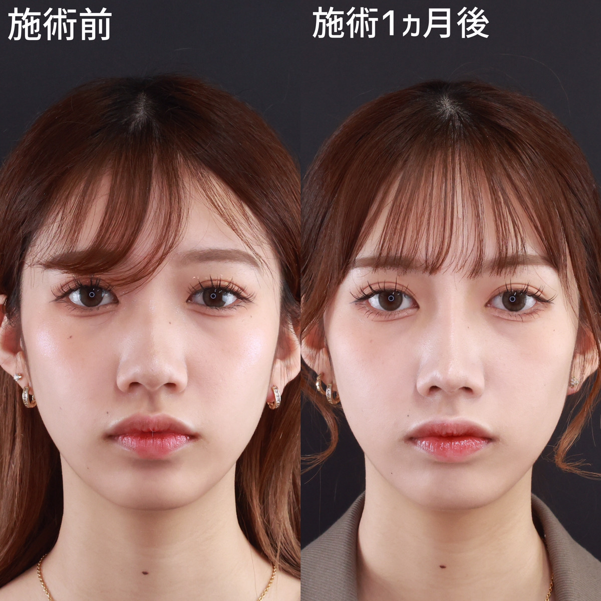 鼻尖形成・鼻尖縮小/鼻先軟骨移植/鼻中隔延長術の症例写真 施術前後 