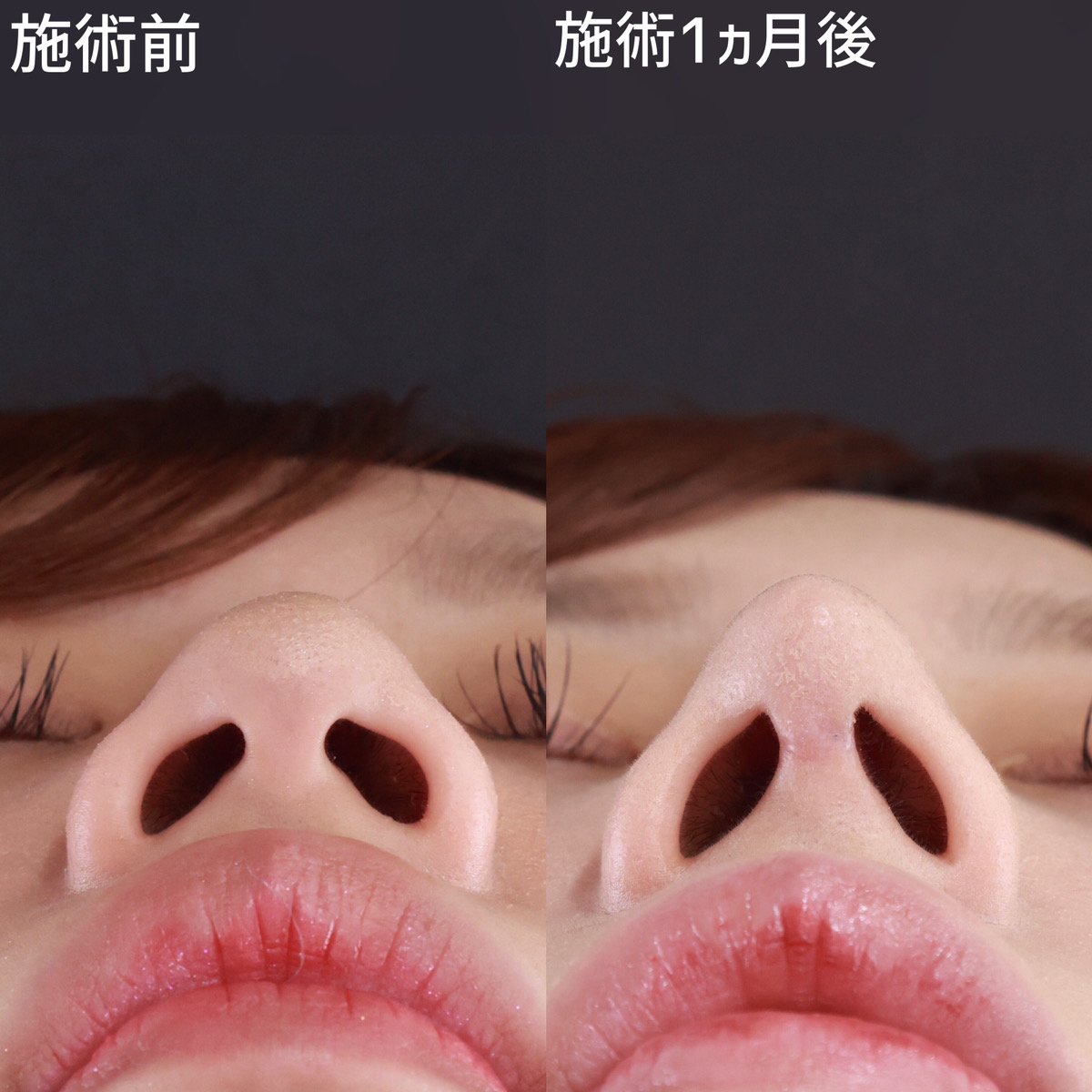 鼻尖形成・鼻尖縮小/鼻先軟骨移植/鼻中隔延長術の症例写真 施術前後 