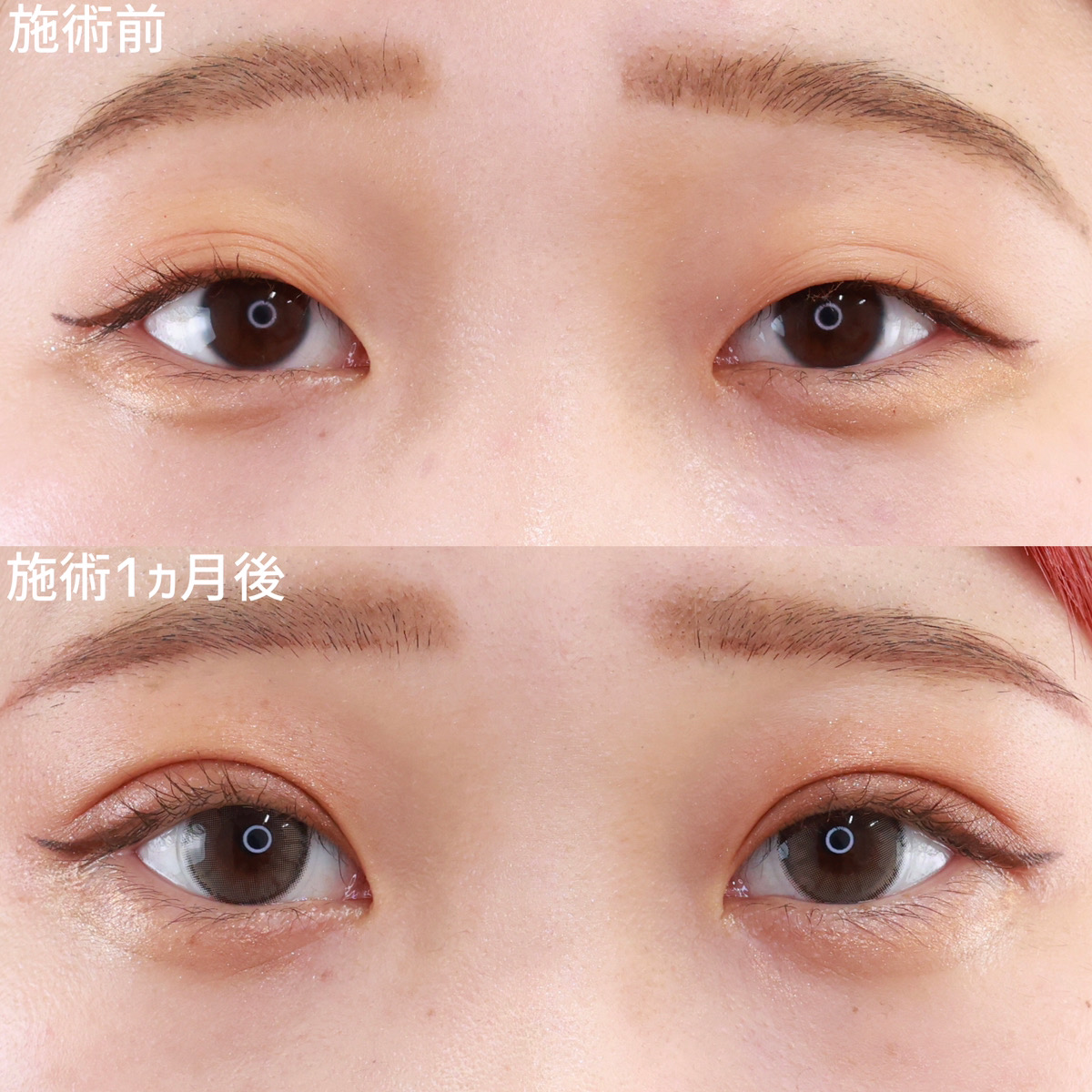 【二重埋没法】メイクが映えるくりっと可愛い目元