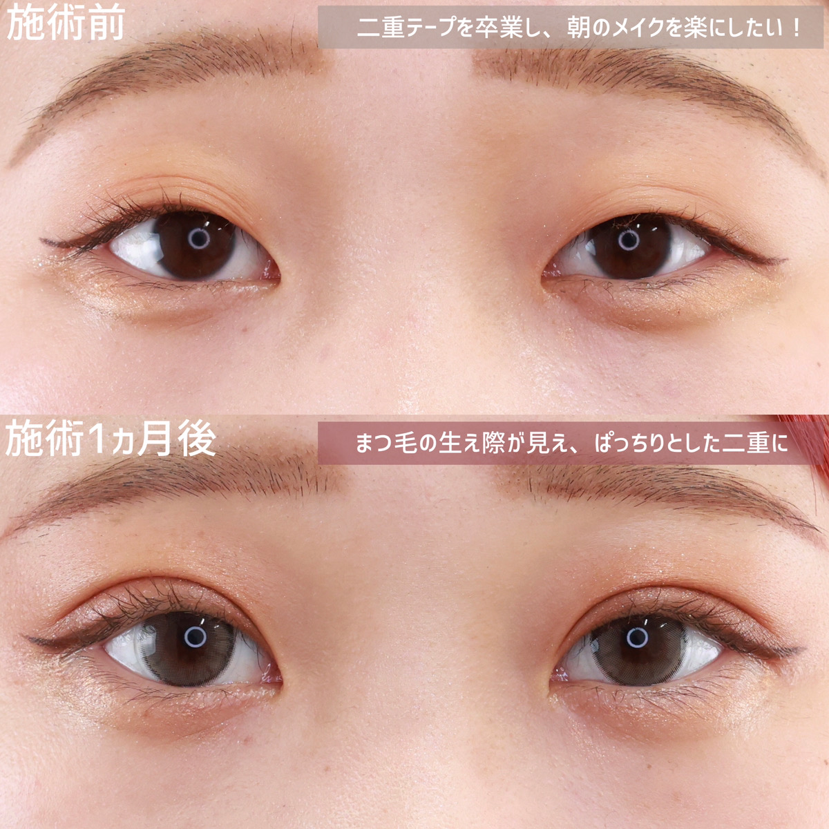 二重埋没法/目元：その他の症例写真 施術前後 