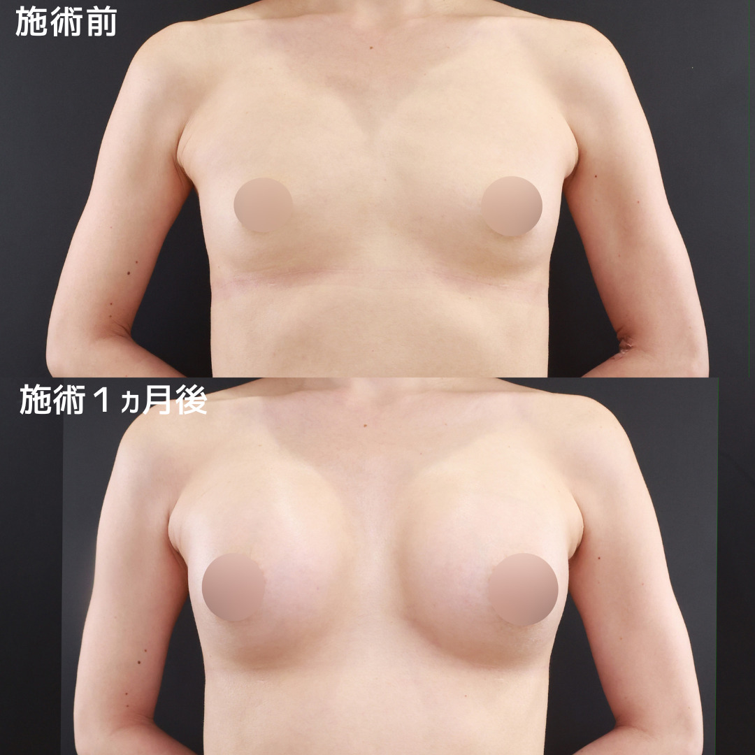 シリコンバッグ豊胸（人工乳腺バッグ）の症例写真 施術前後 
