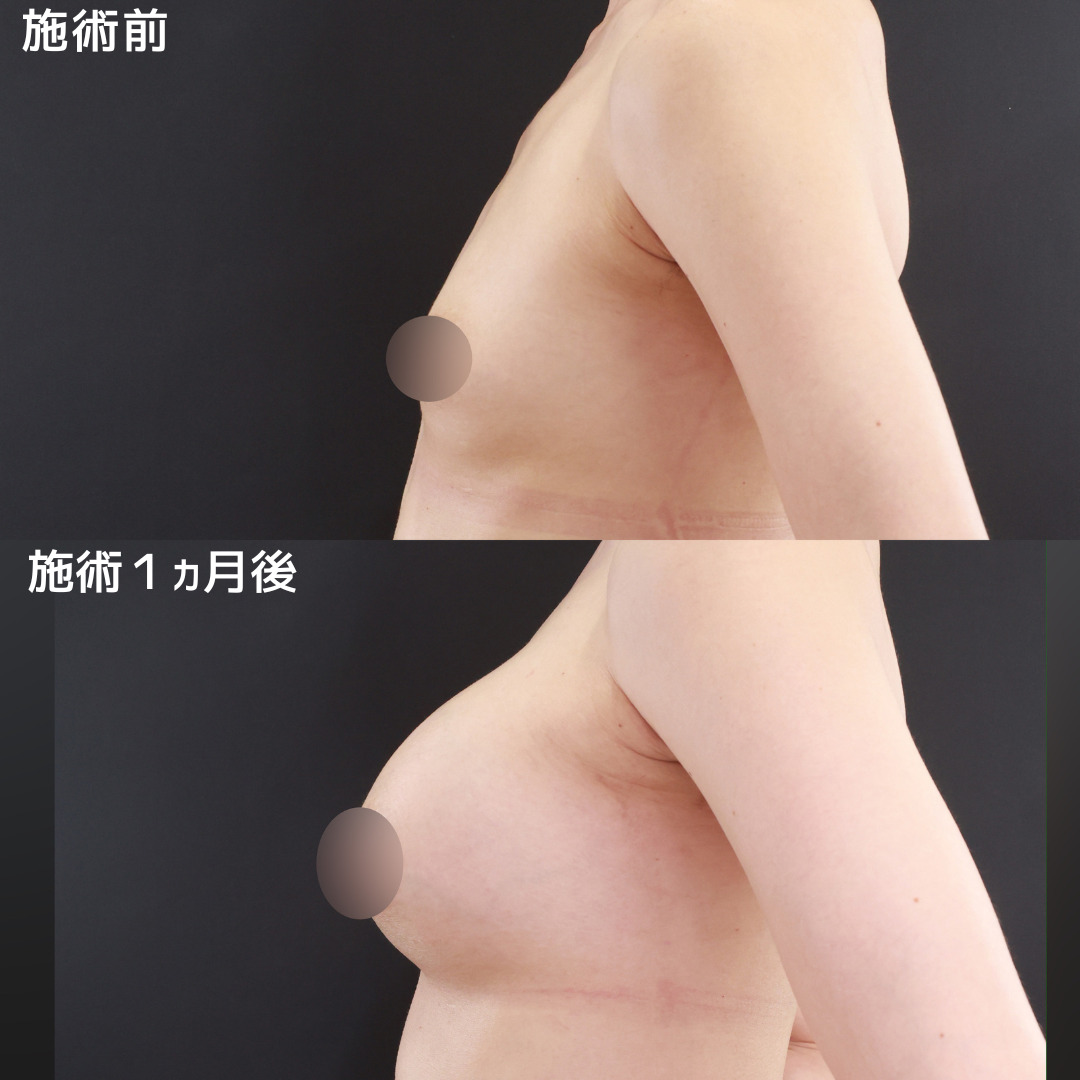シリコンバッグ豊胸（人工乳腺バッグ）の症例写真 施術前後 