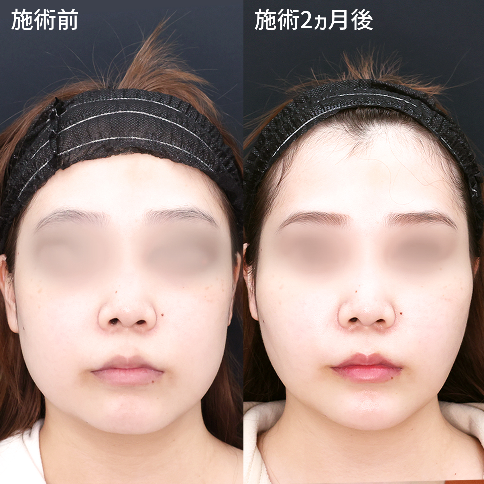 【糸リフト】×【バッカルファット除去】でもたつき解消！　スッキリ美しいお顔に！！