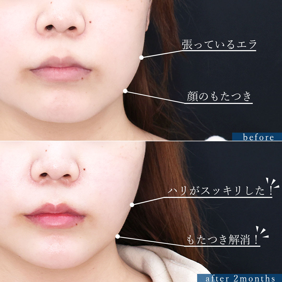 TAC式 ツヤ肌コラーゲンリフト®/バッカルファット除去/顎のヒアルロン酸注射の症例写真 施術前後 