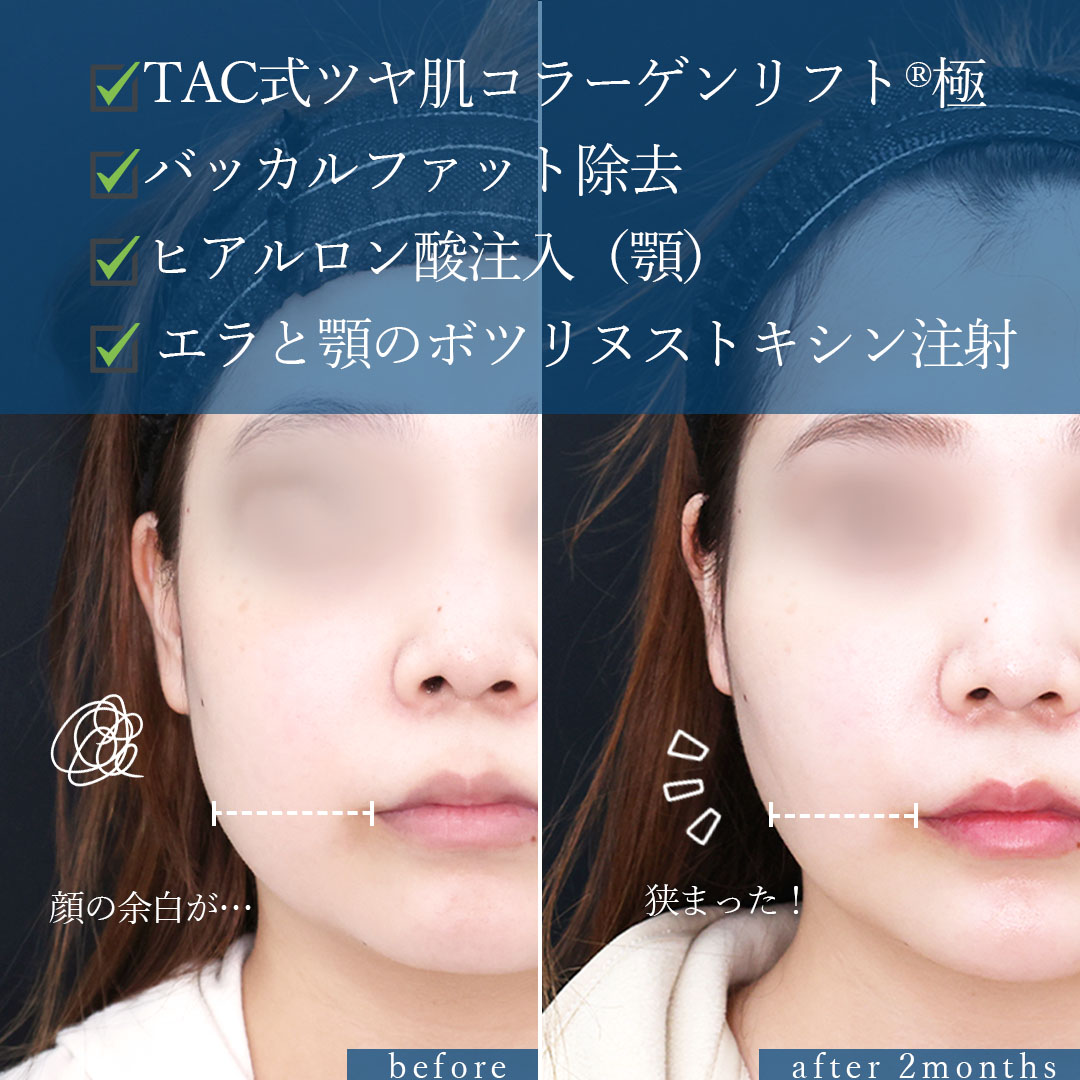 TAC式 ツヤ肌コラーゲンリフト®/バッカルファット除去/顎のヒアルロン酸注射の症例写真 施術前後 