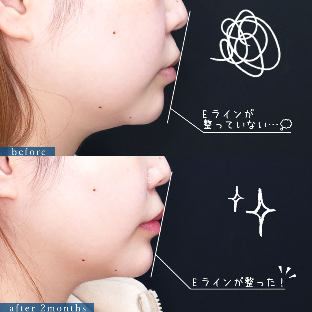 TAC式 ツヤ肌コラーゲンリフト®/バッカルファット除去/顎のヒアルロン酸注射の症例写真 施術前後 