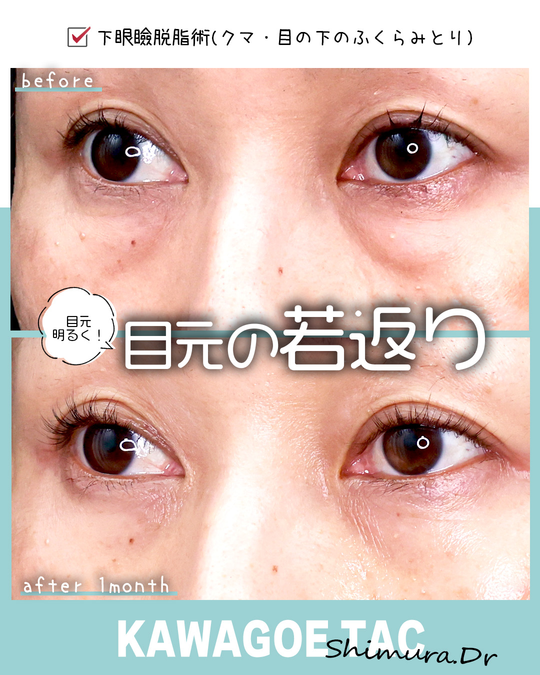 下眼瞼脱脂術（目の下のたるみ取り・目の下の脂肪ふくらみ取り）の症例写真 施術前後 