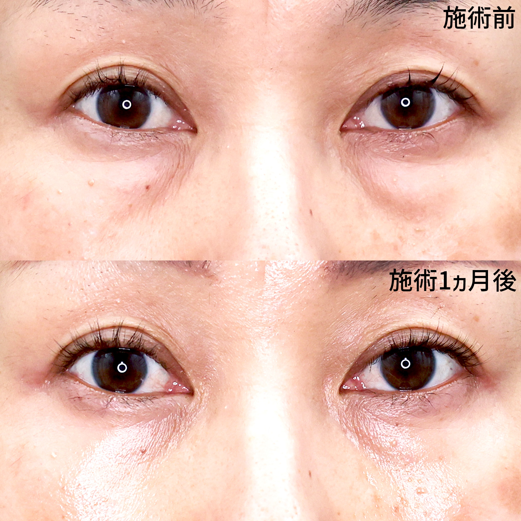 目の下をスッキリさせ、若々しい印象へ！！