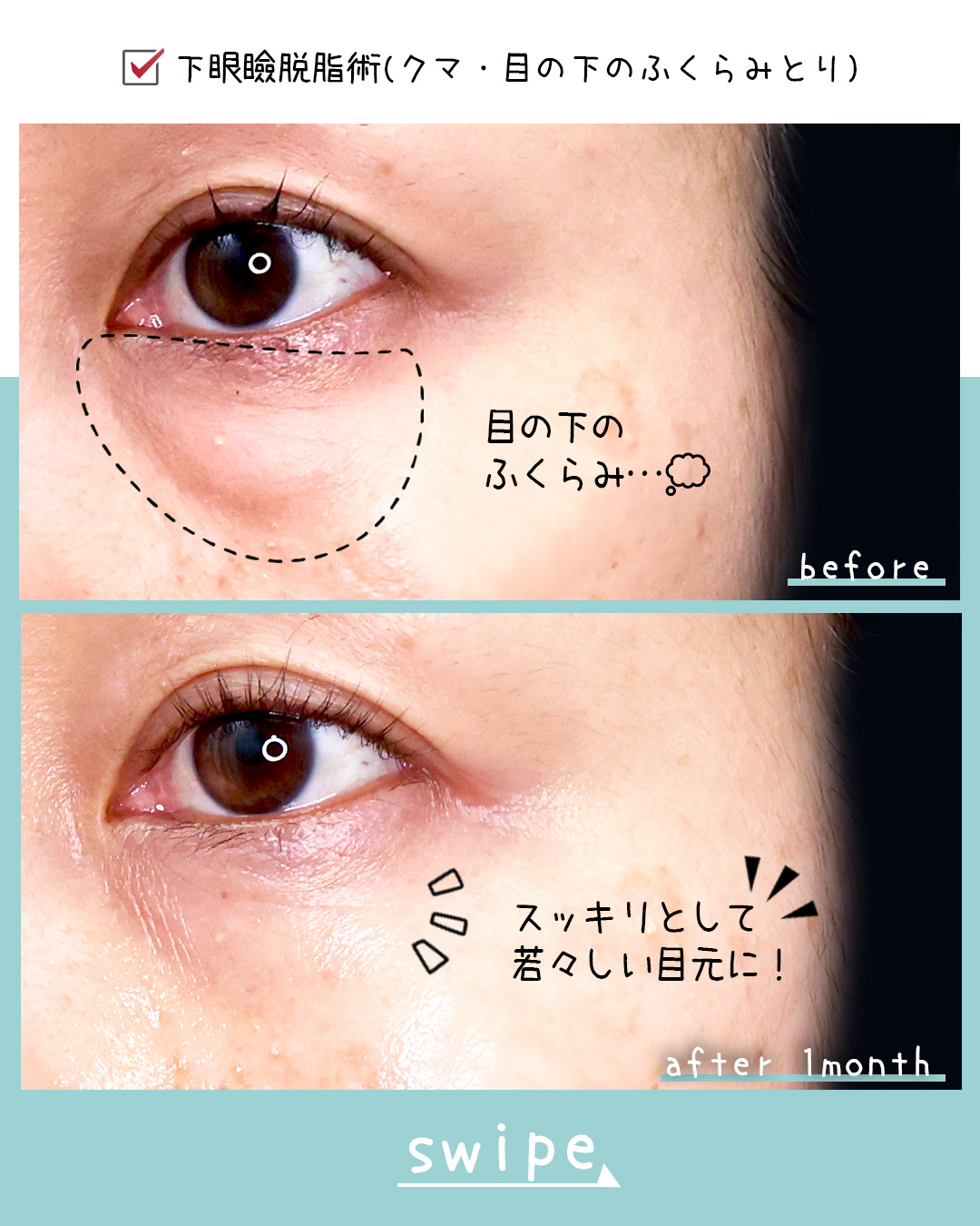 下眼瞼脱脂術（目の下のたるみ取り・目の下の脂肪ふくらみ取り）の症例写真 施術前後 