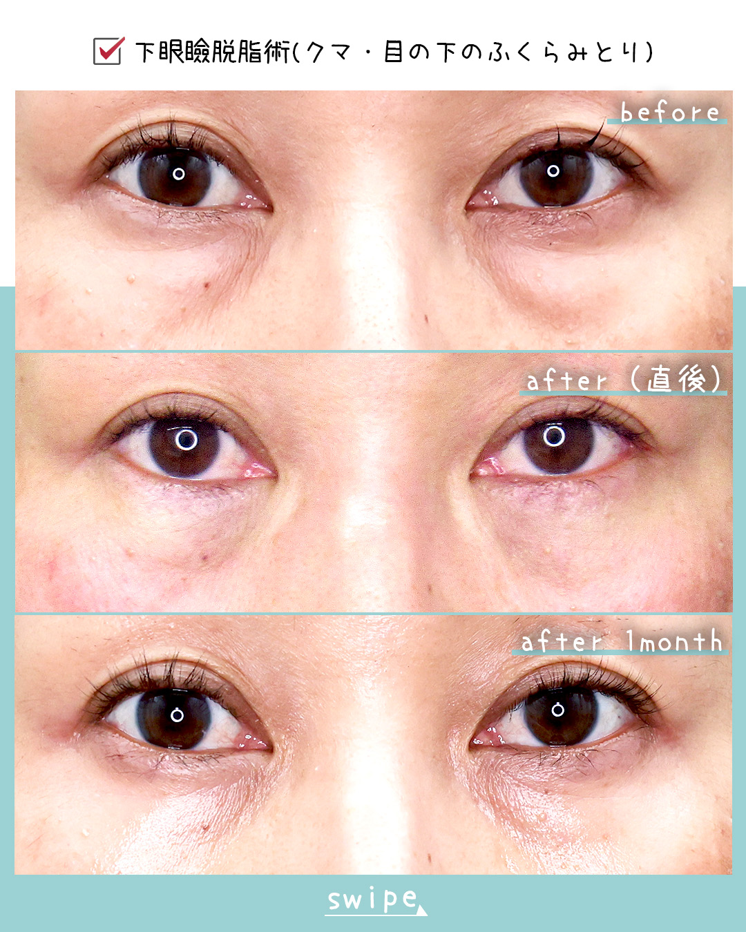 下眼瞼脱脂術（目の下のたるみ取り・目の下の脂肪ふくらみ取り）の症例写真 施術前後 