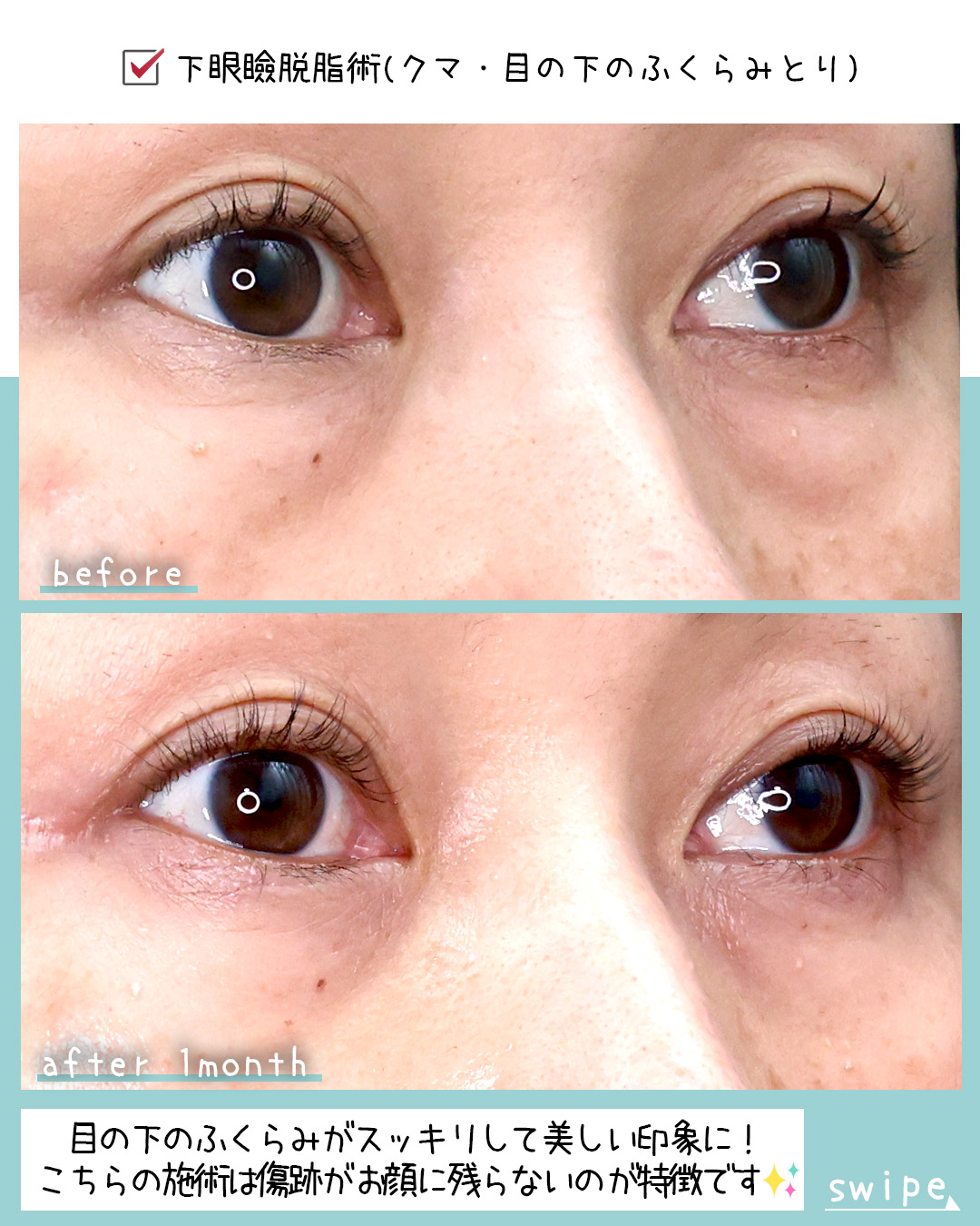 下眼瞼脱脂術（目の下のたるみ取り・目の下の脂肪ふくらみ取り）の症例写真 施術前後 