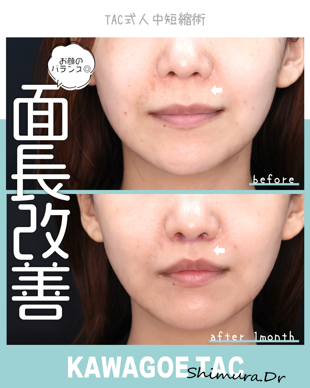 人中短縮術(リップリフト)・外側人中短縮術の症例写真 施術前後 