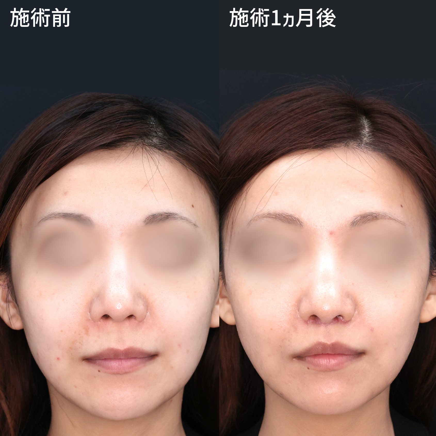 顔のバランスが気になる……そんなあなたに『人中短縮術』