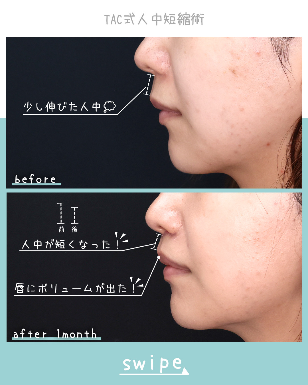 人中短縮術(リップリフト)・外側人中短縮術の症例写真 施術前後 